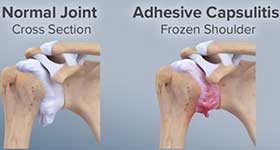Frozen Shoulder