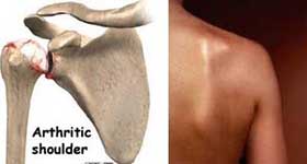 Osteo Arthritis of the Shoulder