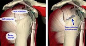 Rotator Cuff Tear