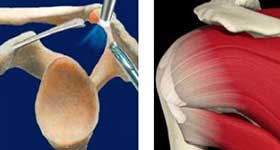 Shoulder Impingement