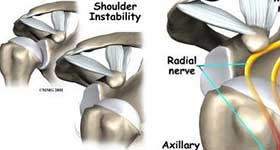 Shoulder Instability